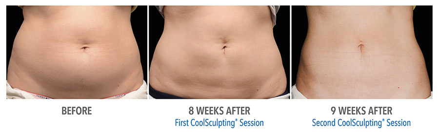 Am I A Candidate For CoolSculpting? - Sacramento Coolsculpting